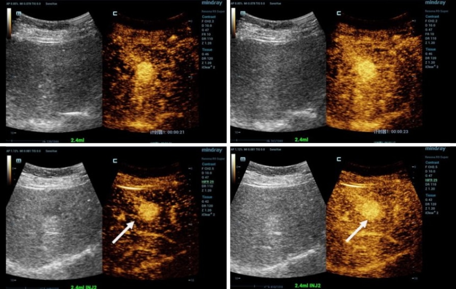 Mindray Hepatus. Більш точна діагностика печінки за допомогою HiFR CEUS Діагностика печінки